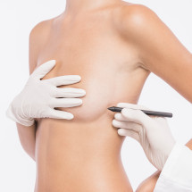 cirugía aumento reducción mamas mastopexia. Clínicas Medicina Estética en Málaga (Fuengirola, Torremolinos, Rincón de la Victoria)