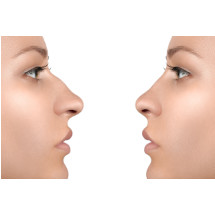 rinoplastia